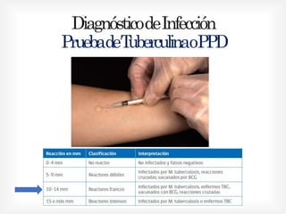 DiagnósticodeInfección
PruebadeTuberculinaoPPD