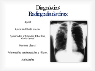 Diagnóstico:
Radiografíadetórax