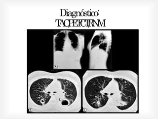 Diagnóstico:
TAC,PET-CT,RNM