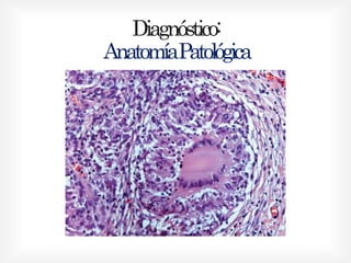 Diagnóstico:
AnatomíaPatológica