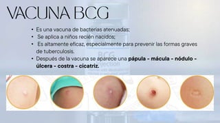 • Es una vacuna de bacterias atenuadas;
• Se aplica a niños recién nacidos;
• Es altamente eficaz, especialmente para prevenir las formas graves
de tuberculosis.
• Después de la vacuna se aparece una pápula - mácula - nódulo -
úlcera - costra - cicatriz.
 