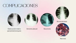 Derrame pleural
Necrosis
Neumonía
Bronquiectasia
Obstrucción total o
parcial de bronquios
 