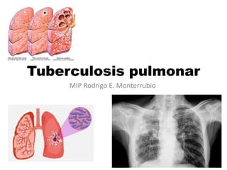 Tuberculosis pulmonar
MIP Rodrigo E. Monterrubio
 