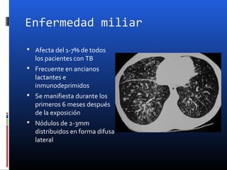 Enfermedad miliar
 Afecta del 1-7% de todos
los pacientes con TB
 Frecuente en ancianos
lactantes e
inmunodeprimidos
 Se manifiesta durante los
primeros 6 meses después
de la exposición
 Nódulos de 2-3mm
distribuidos en forma difusa
lateral
 