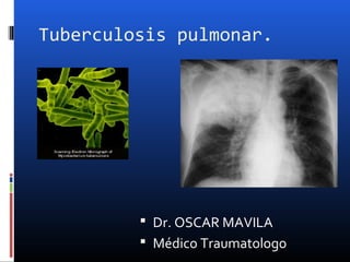 Tuberculosis pulmonar.
 Dr. OSCAR MAVILA
 Médico Traumatologo
 