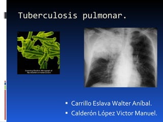 Tuberculosis pulmonar.  ,[object Object],[object Object]