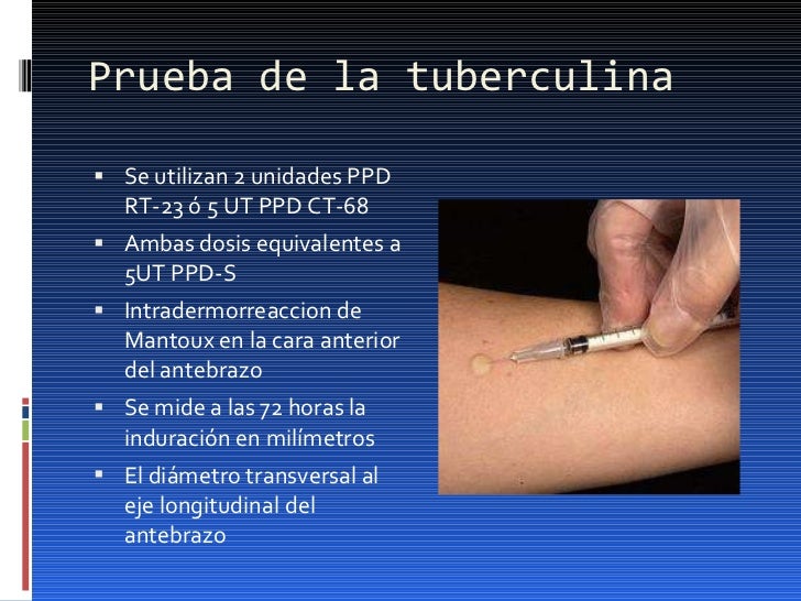 Tuberculosis pulmonar buena Tuberculosis pulmonar buena