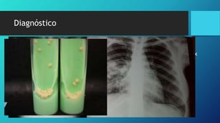 Tuberculosis pulmonar 