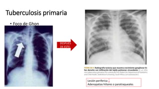 • Foco de Ghon
DESPUES
DE ESTE:
Lesión periferica
Adenopatias hiliares o paratraqueales
Tuberculosis primaria
 