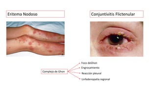 Eritema Nodoso Conjuntivitis Flictenular
Complejo de Ghon
Reacción pleural
Linfadenopatía regional
Engrosamiento
Foco deGhon
 