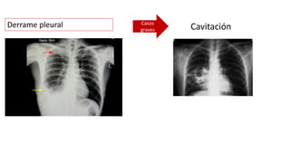 Casos
graves Cavitación
Derrame pleural
 