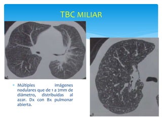 TBC MILIAR
 Múltiples imágenes
nodulares que de 1 a 2mm de
diámetro, distribuidas al
azar. Dx con Bx pulmonar
abierta.
 