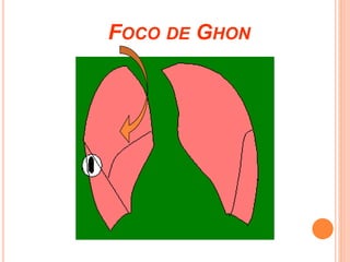 FOCO DE GHON
 