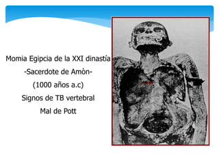 Momia Egipcia de la XXI dinastía
-Sacerdote de Amòn-
(1000 años a.c)
Signos de TB vertebral
Mal de Pott
 