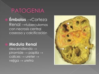 Tuberculosis renal | PPTX