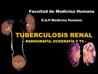TUBERCULOSIS RENAL
- RADIOGRAFÍA, ECOGRAFÍA Y TC -
Facultad de Medicina Humana
E.A.P.Medicina Humana
 