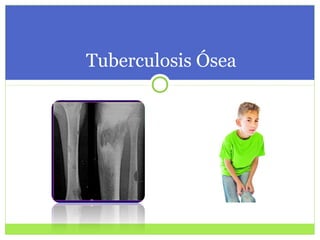 Tuberculosis Ósea 
 