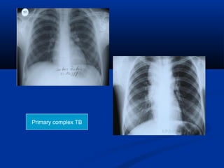 Tuberculosis seminar. | PPT