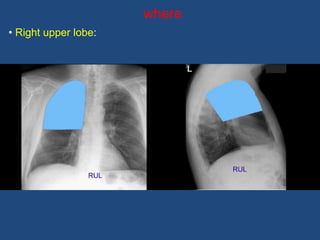 where
• Right upper lobe:
 