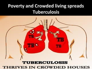 Poverty and Crowded living spreads
Tuberculosis
Dr.T.V.Rao MD 14
 