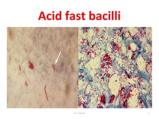 Acid fast bacilli
Dr.T.V.Rao MD 23
 
