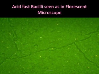 Acid fast Bacilli seen as in Florescent
Microscope
• After staining with Ziehl
Neelsen method or
Fluorescent method
( Auramine or Rhodamine
they resist decolonization
by 20% Sulphuric acid and
absolute alcohol for 10 mt,
• So called as Acid and
Alchool fast.
Dr.T.V.Rao MD 24
 