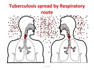 Tuberculosis spread by Respiratory
route
Dr.T.V.Rao MD 47
 