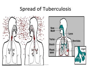 Spread of Tuberculosis
Dr.T.V.Rao MD 51
 