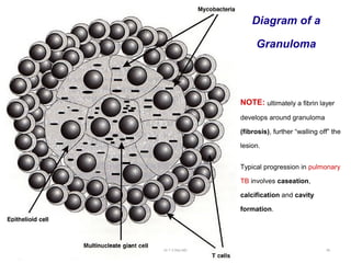 Diagram of a
Granuloma
NOTE: ultimately a fibrin layer
develops around granuloma
(fibrosis), further “walling off” the
lesion.
Typical progression in pulmonary
TB involves caseation,
calcification and cavity
formation.
Dr.T.V.Rao MD 59
 