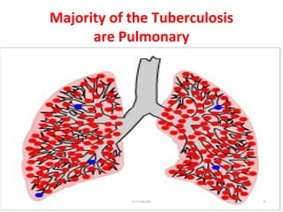 Majority of the Tuberculosis
are Pulmonary
Dr.T.V.Rao MD 70
 