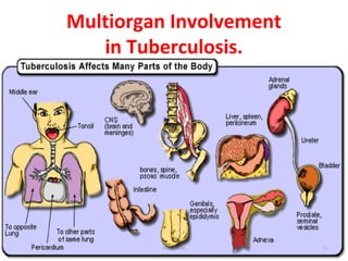 Multiorgan Involvement
in Tuberculosis.
Dr.T.V.Rao MD 71
 