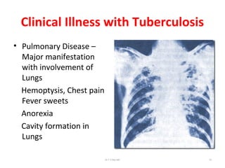 Clinical Illness with Tuberculosis
• Pulmonary Disease –
Major manifestation
with involvement of
Lungs
Hemoptysis, Chest pain
Fever sweets
Anorexia
Cavity formation in
Lungs
Dr.T.V.Rao MD 74
 