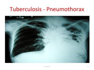 Tuberculosis - Pneumothorax
Dr.T.V.Rao MD 75
 