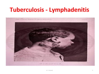 Tuberculosis - Lymphadenitis
Dr.T.V.Rao MD 77
 