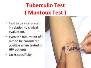 Tuberculin Test
( Mantoux Test )
• Test to be interpreted
in relation to clinical
evaluation.
• Even the induration of 5
mm to be considered
positive when tested on
HIV patients.
• Lacks specificity.
 