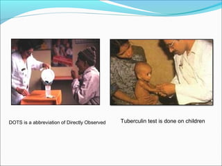 Tuberculin test is done on childrenDOTS is a abbreviation of Directly Observed
 