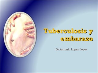 Tuberculosis y
embarazo
Dr.Antonio Lopez Lopez

 