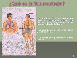La tuberculosis es una enfermedad
infecciosa y contagiosa producida por
una bacteria que se conoce con el
nombre de Bacilo de Koch.
La tuberculosis puede ser pulmonar
y extra-pulmonar.
La tuberculosis pulmonar es la más
frecuente.
2
 