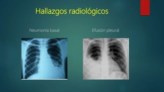 Hallazgos radiológicos
Neumonía basal Efusión pleural
 