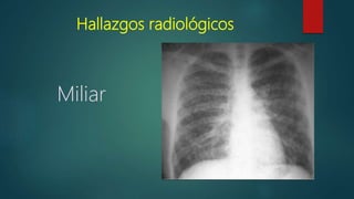 Hallazgos radiológicos
Miliar
 