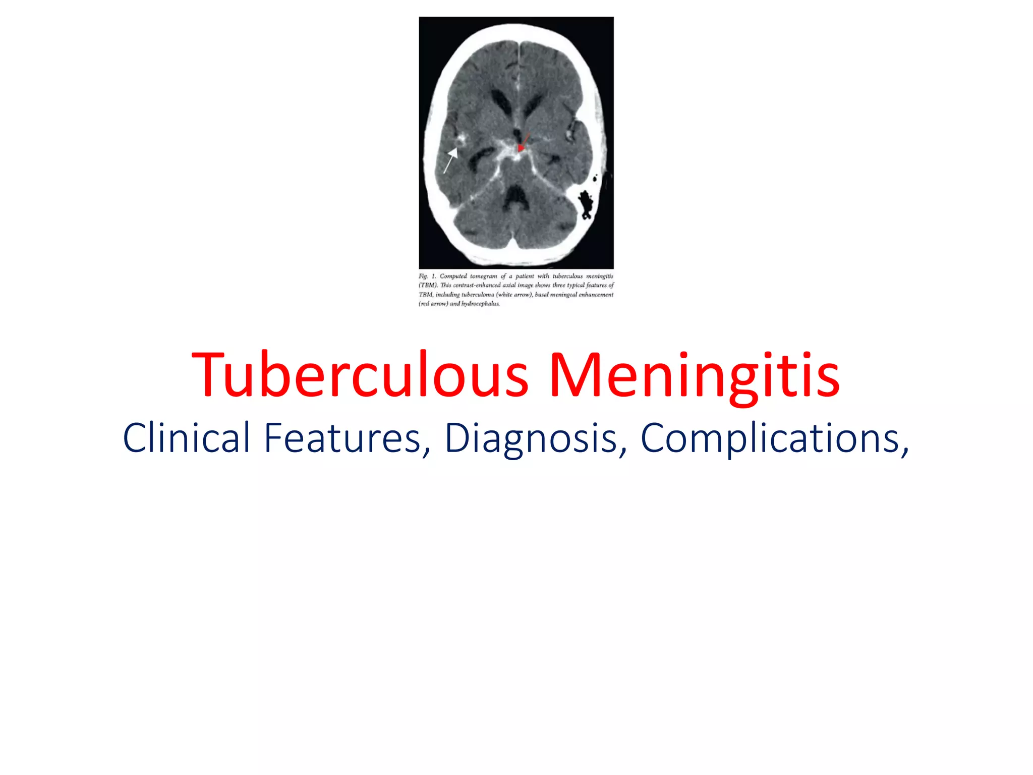 Tuberculous meningitis in children 2021 | PDF