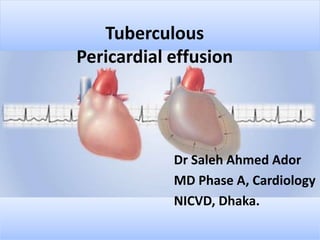 Tuberculous
Pericardial effusion
Dr Saleh Ahmed Ador
MD Phase A, Cardiology
NICVD, Dhaka.
 