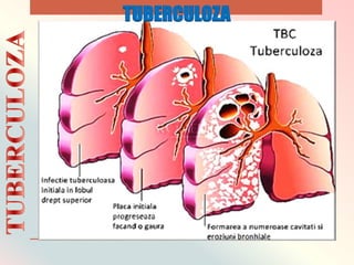 TUBERCULOZA
 