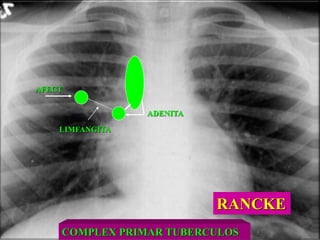 COMPLEX PRIMAR TUBERCULOS
AFECT
LIMFANGITA
ADENITA
RANCKE
 