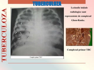 Leziunile inițiale
radiologice sunt
reprezentate de complexul
Ghon-Ranke.
Complexul primar TBC
TUBERCULOZA
 
