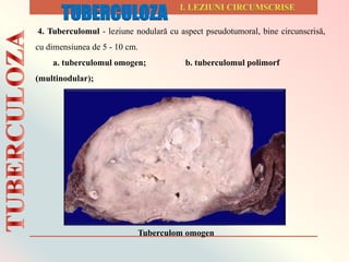 4. Tuberculomul - leziune nodulară cu aspect pseudotumoral, bine circunscrisă,
cu dimensiunea de 5 - 10 cm.
a. tuberculomul omogen; b. tuberculomul polimorf
(multinodular);
c. tuberculomul stratificat.
Tuberculom omogen
TUBERCULOZA
 