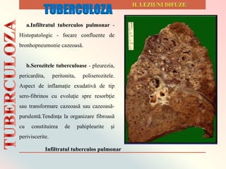 a.Infiltratul tuberculos pulmonar -
Histopatologic - focare confluente de
bronhopneumonie cazeoasă.
b.Serozitele tuberculoase - pleurezia,
pericardita, peritonita, poliserozitele.
Aspect de inflamaţie exudativă de tip
sero-fibrinos cu evoluţie spre resorbţie
sau transformare cazeoasă sau cazeoasă-
purulentă.Tendinţa la organizare fibroasă
cu constituirea de pahipleurite şi
periviscerite.
Infiltratul tuberculos pulmonar
TUBERCULOZA
 