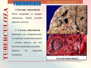 1.Ulceraţia tuberculoasă -
formă neregulată cu margini
anfractuase; fundul prezintă
depozite cazeoase.
2. Caverna tuberculoasă -
pulmonară sau extrapulmonară,
se constituie în perioada primară
- caverna precoce, sau mai
frecvent în perioada secundară.
Ruperea lor determină
hemoptizii.
Cavernă tuberculoasă
TUBERCULOZA
 
