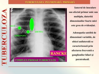 Şancrul de inoculare
sau afectul primar unic sau
multiplu, datorită
dimensiunilor foarte mici
este greu de evidenţiat.
Adenopatia satelită de
dimensiuni variabile, de
obicei unilaterală se
caracterizează prin
afectarea frecventă a
ganglionilor hilari şi
paratraheali.
 