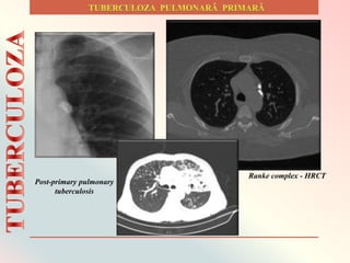 Ranke complex - HRCT
Post-primary pulmonary
tuberculosis
 